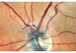 Occlusione di Branca Arteriosa Retinica (BRAO)